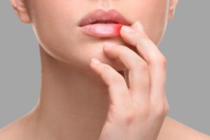 Bouton de fièvre (herpès labial)