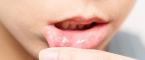 Aphte de la bouche : symptômes et causes