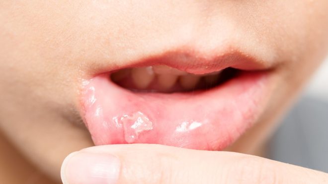 Aphte de la bouche : symptômes et causes