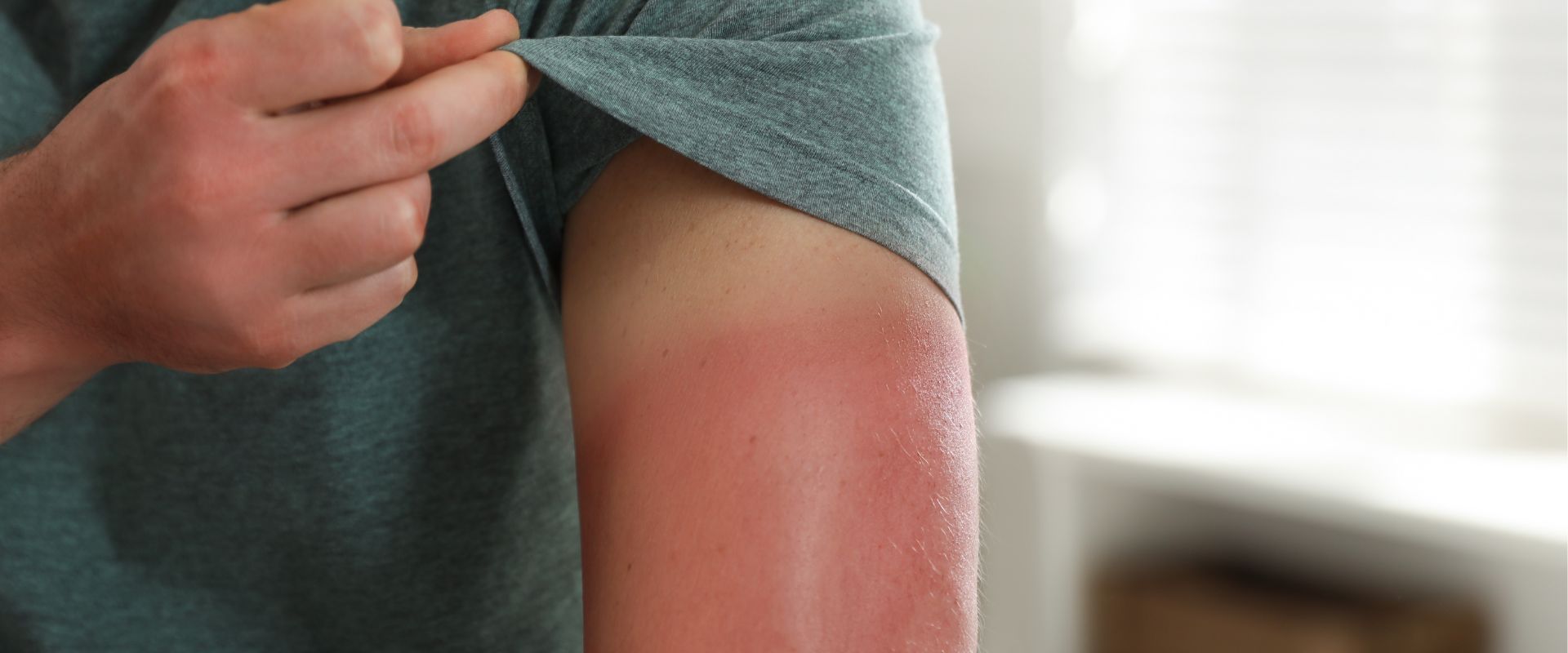 Lire la suite à propos de l’article Coup de soleil : que faire et quand consulter ?