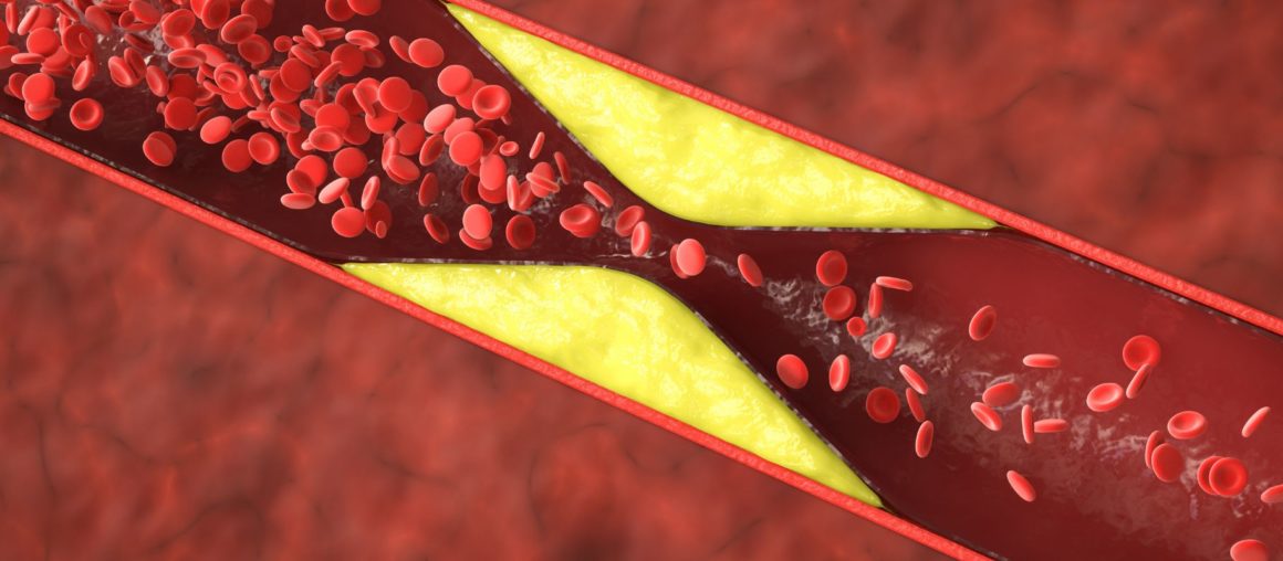 Anomalies du cholestérol et des triglycérides : causes et conséquences