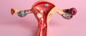 Mycose vaginale et autres vaginites : que faire ?