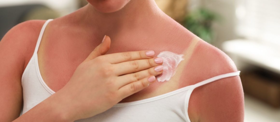 Coup de soleil et conséquences sur la santé de l'exposition au soleil