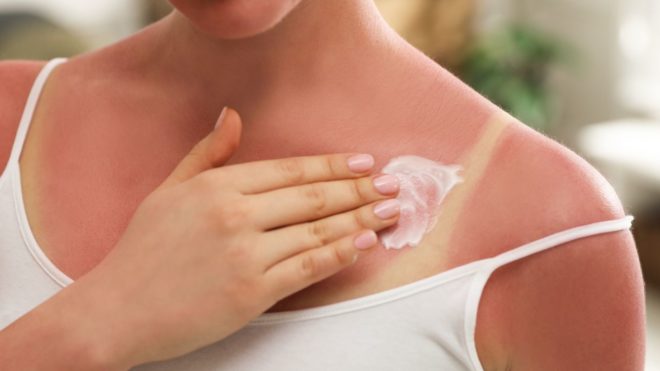 Coup de soleil et conséquences sur la santé de l'exposition au soleil