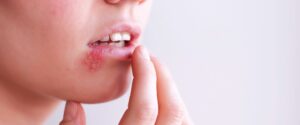 Lire la suite à propos de l’article Reconnaitre un herpès labial ou bouton de fièvre