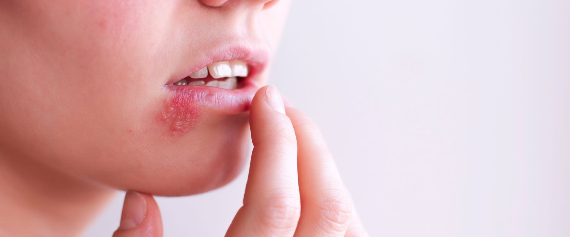 Lire la suite à propos de l’article Reconnaitre un herpès labial ou bouton de fièvre