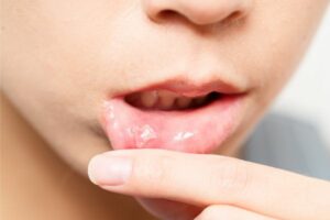 Aphte de la bouche : symptômes et causes