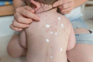 Varicelle : que faire et quand consulter ?